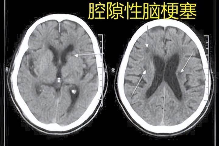 中老年人群常见疾病：腔梗！日常注意4个症状，做好早期预防