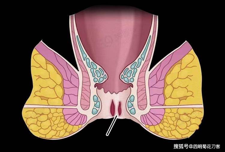 【彭医生谈肛肠】肛裂出血发痒，怎么办？