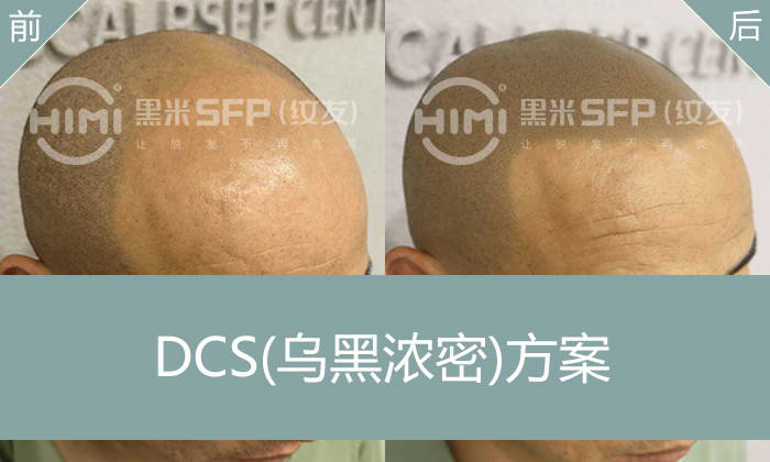 发际线往后移可以纹发吗？找回失去的发际线