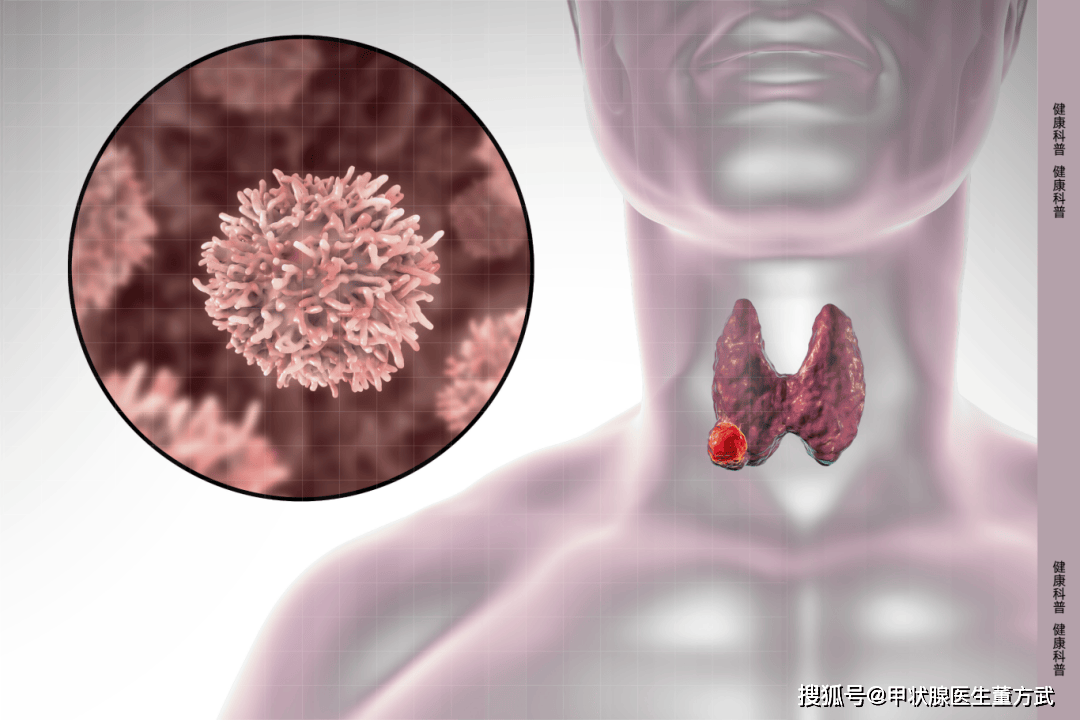 14类人易患甲状腺疾病，须格外重视！5种常见甲状腺疾病症状及预防方法(图1)