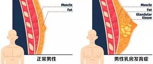 关注男性乳腺发育，男性乳腺健康也很重要(图1)