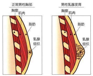 男性乳腺发育的诊断(图1)