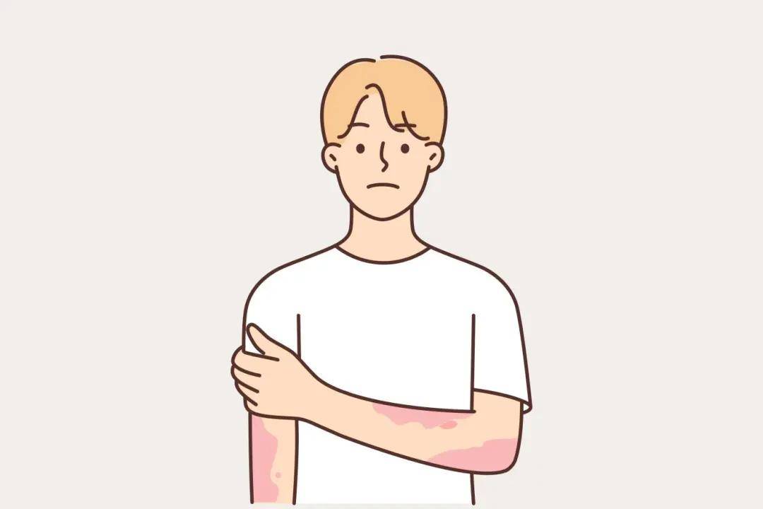 秋季得了荨麻疹怎么办？