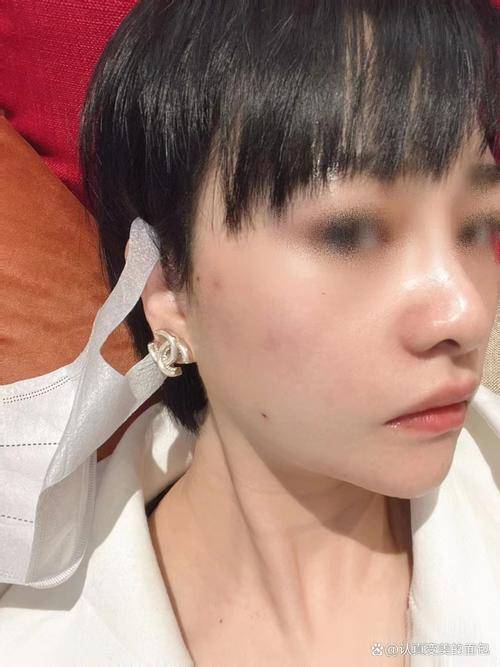 线雕手术三年后脸上钻出线？揭秘潜在风险