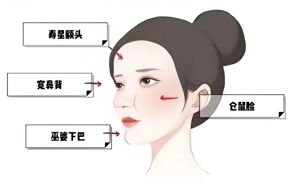 太原整形张伟：面部填充“馒化脸”的形成原因