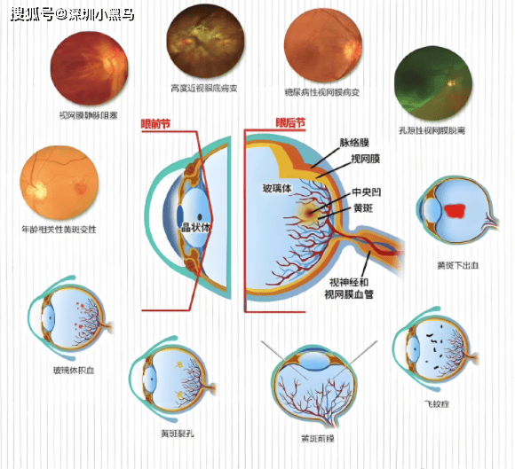 高度近视真的会引起眼底病变吗？