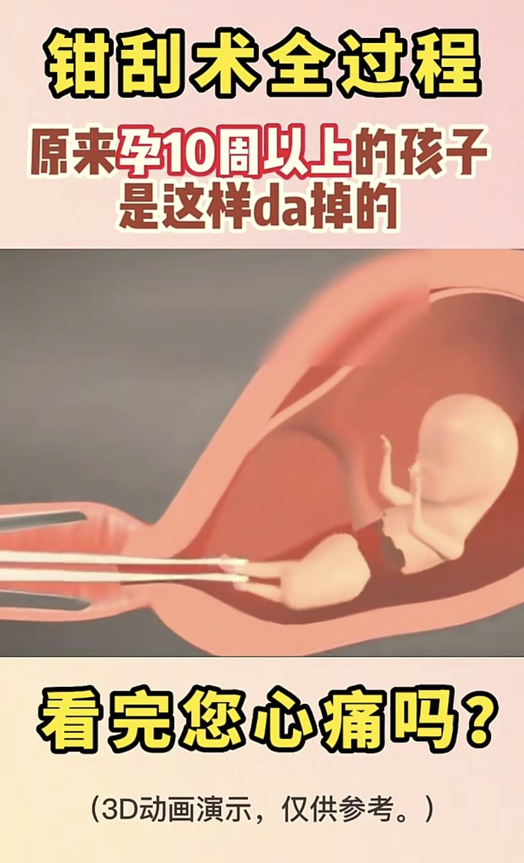 怀孕超过这孕周医生不让流产!大月龄引产3D图让人惊呼:残忍