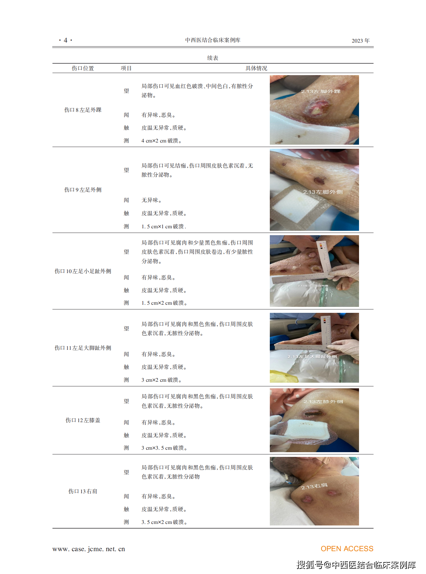 示范案例|1例全身多处压力性损伤患者的护理