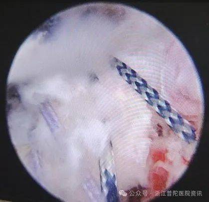 山海提升｜微创关节镜手术显身手，解决诸多病痛与烦愁