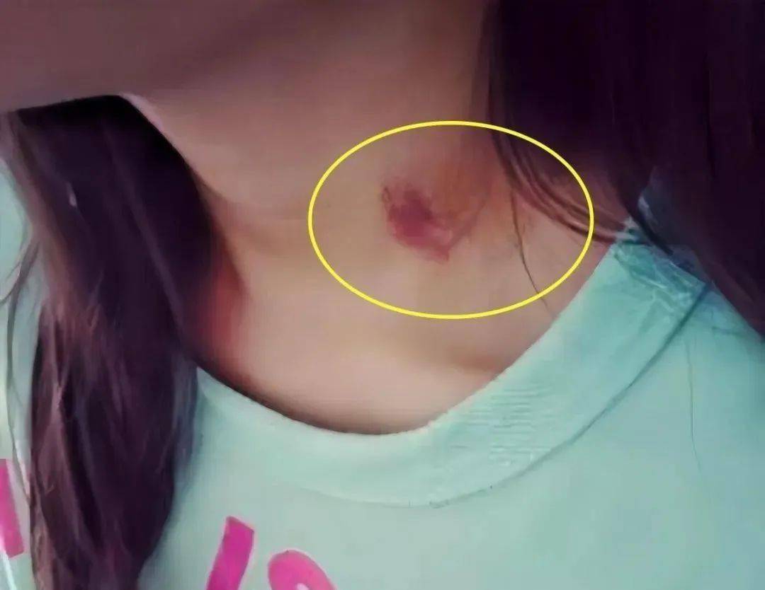 【今日话题】15岁女儿脖子上出现“吻痕”，爸爸不停逼问，孩子的话引父母深思，机智！发现女儿偷看“情色