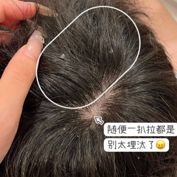 夏天头发出油有头屑用什么洗发水？去屑止痒最好的洗发水推荐