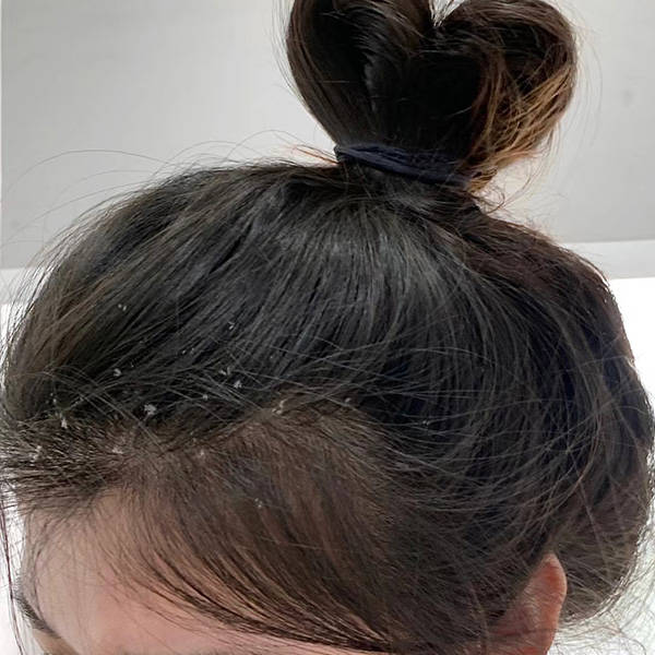 大块头皮屑是什么原因引起的？去屑滋润的洗发水推荐