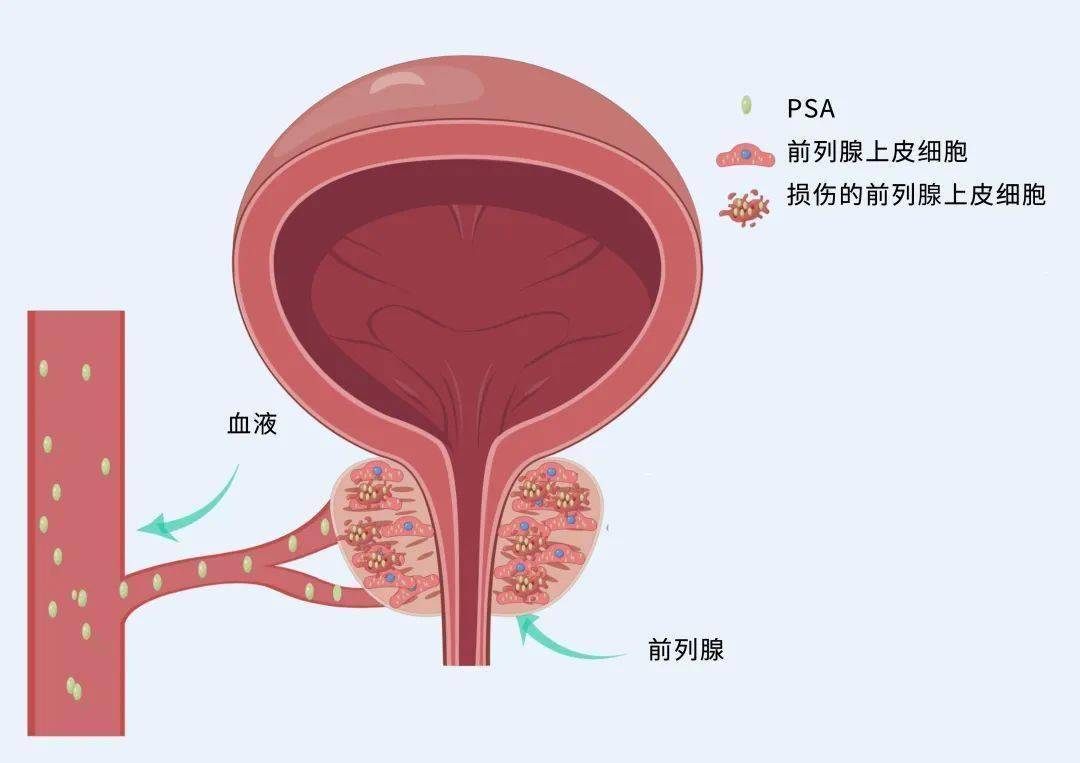 美国总统每年都体检，为什么没查出拜登的前列腺癌？