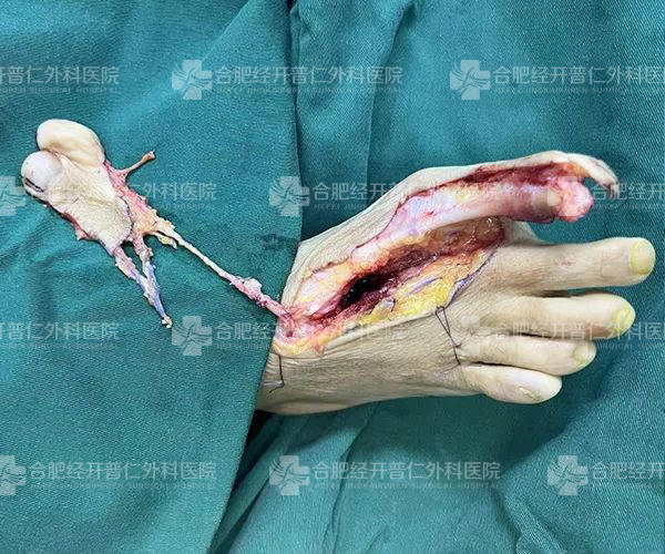 合肥经开普仁外科医院手足外科五月份部分典型病例