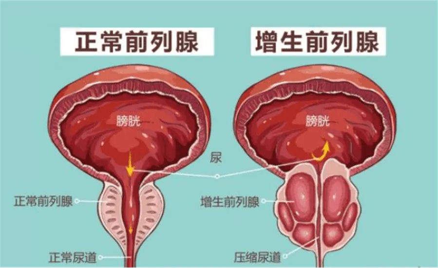 前列腺增生8大危害,中老年大叔要小心,千万别大意