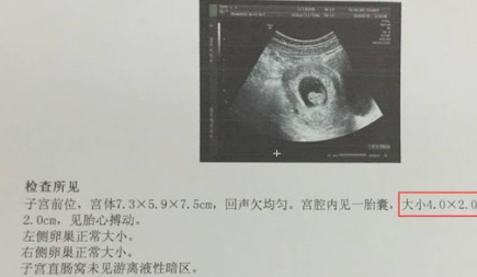 怀孕b超图一个月图片