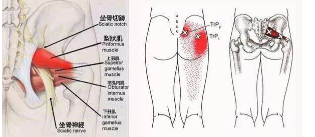 坐骨神經痛有辦法治好嗎?_坐姿_肌肉_治療