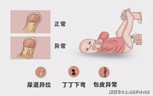 尿道下裂有三个典型的特点,家长可以根据这些特点,仔细观察孩子的尿道