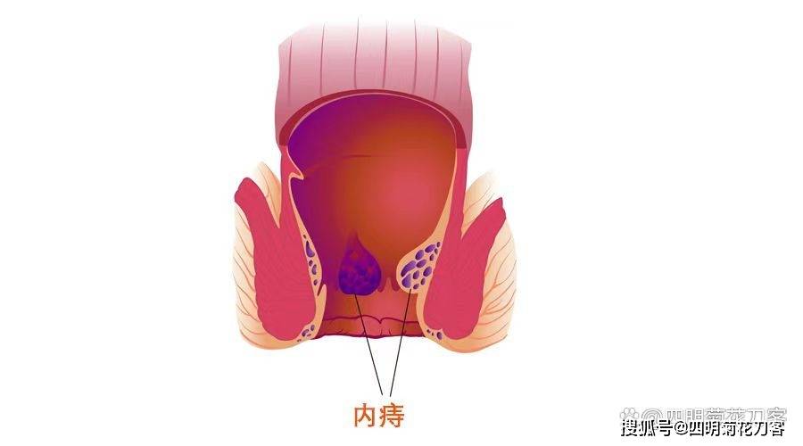 正常肛门 痔疮图片