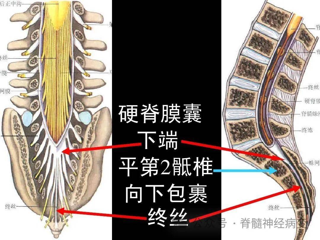 脊髓终丝图片