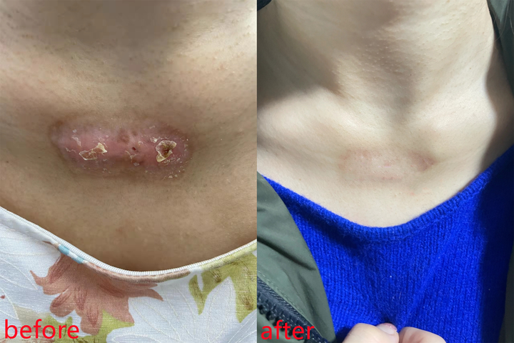 90天就将丑陋的疤痕增生给淡化了,效果杠杠滴_产品_质地_凝胶