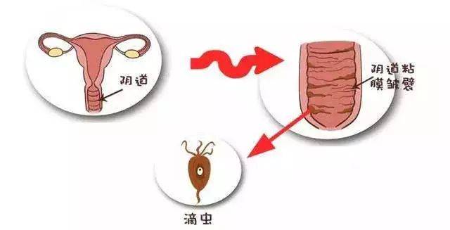 临床表现:白色或黄色白带增多,偶有泡沫状脓性白带且白带有臭味,外阴