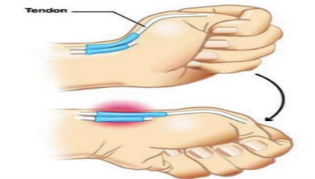 出現這幾種症狀,很可能是腱鞘炎找上你了!_肌腱_生活_痛感