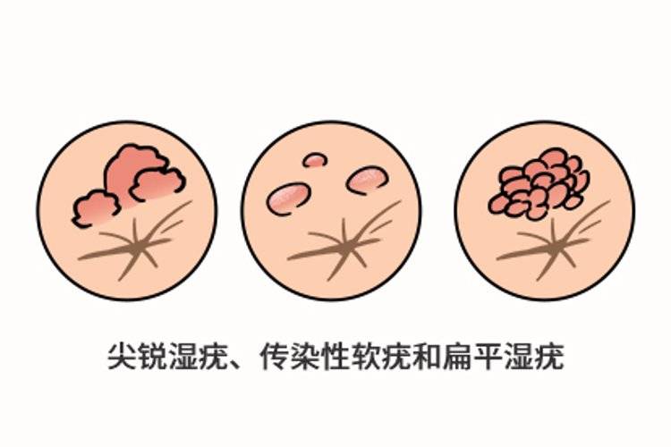 病,湿疹或特应性皮炎,放射性皮炎,多形红斑,脂溢性皮炎,扁平苔藓等