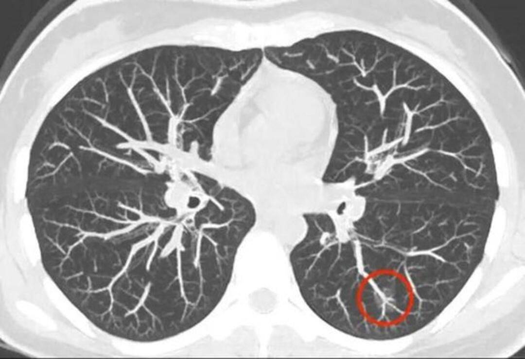 吳海霞主任:肺結節=氣滯血瘀,中醫治療還你一個健康的肺_cm_分類_患者