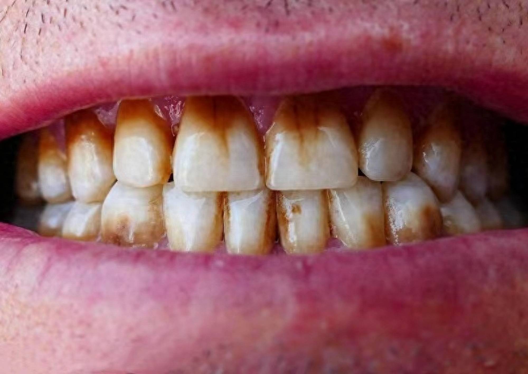 几十块钱赶走烟渍,茶渍,咖啡渍,牙齿亮白如新_问题_男朋友_效果