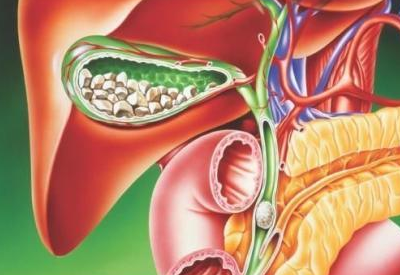 体检发现胆囊结石,不处理的话,以后会怎么样?