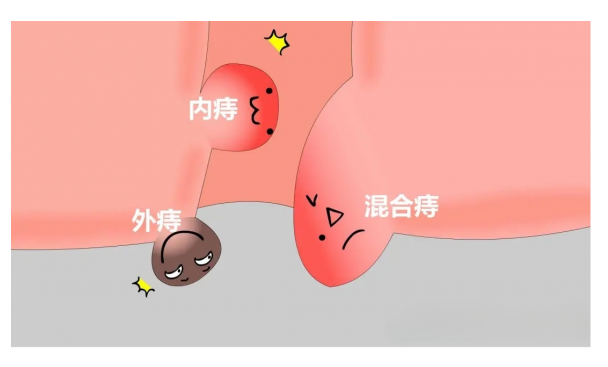 正常的菊花和有痔疮图片