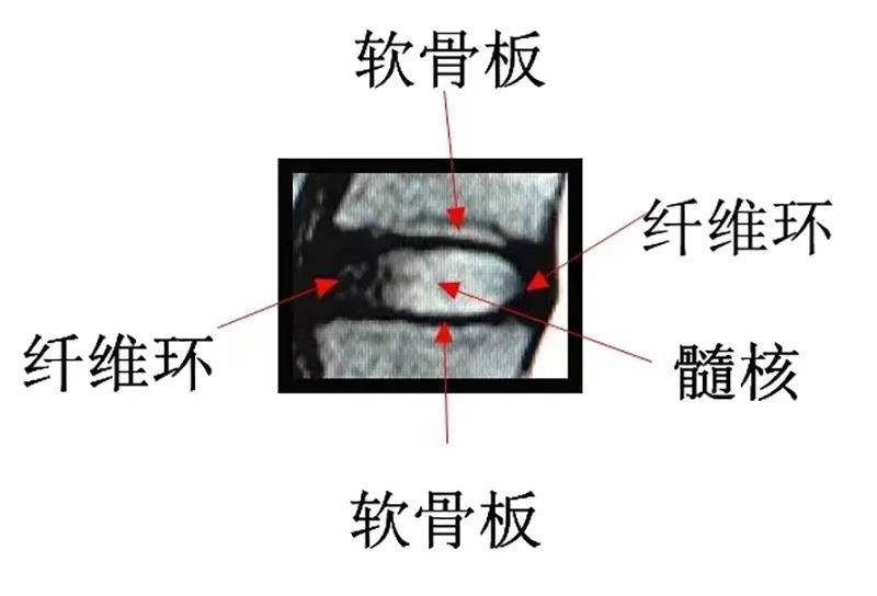 髓核外有較為堅強的纖維包裹,上下有更堅強的軟骨板密封.