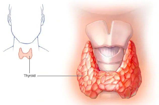 反复脖子疼痛?小心 这也许是甲状腺疾病的前兆