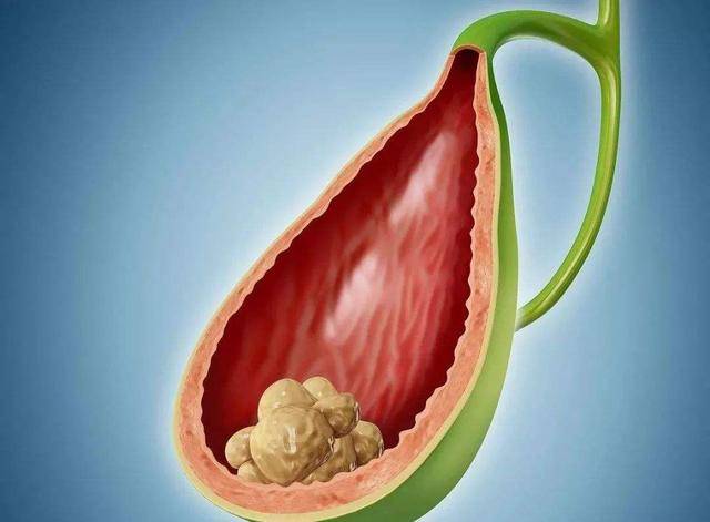 3种疾病或会找上门,能不切别切_胆汁_治疗_症状