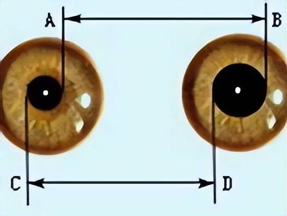 全身麻醉苏醒期双侧瞳孔不等大的可能原因