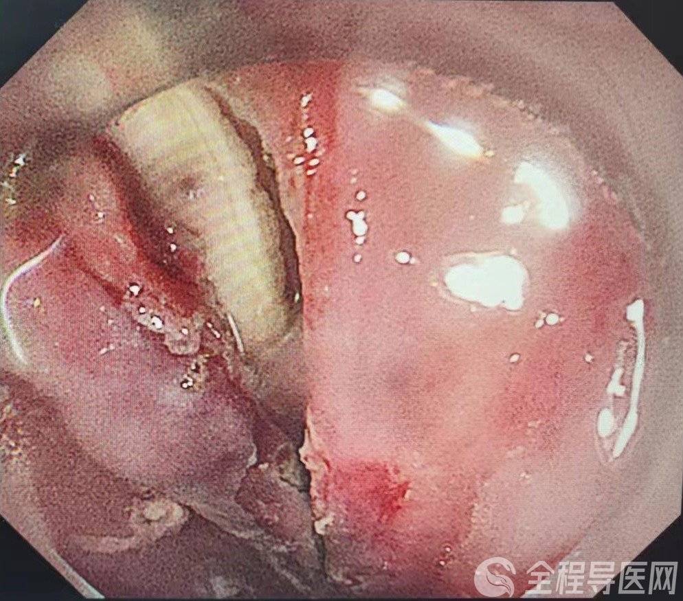 徐医附院内镜下取出消失的鱼刺_异物_食管_黏膜