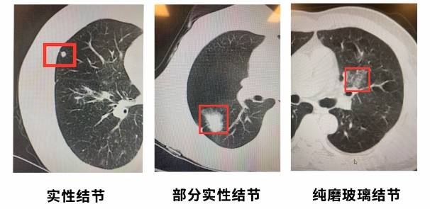 肺结节大小图片