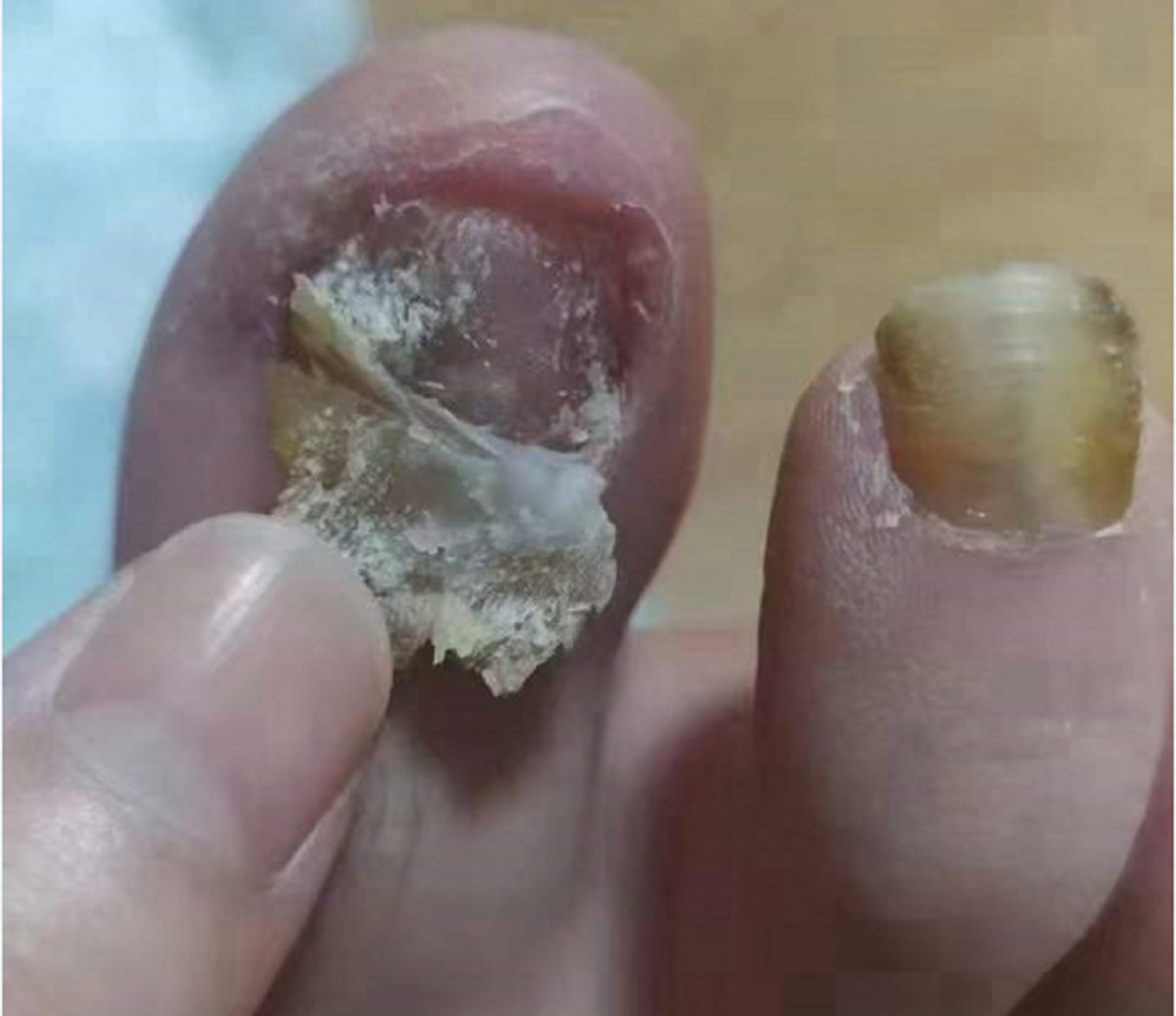 灰指甲的照片真菌感染图片