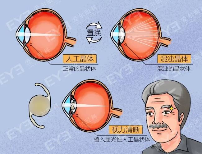 用技术硬实力保障手术质量,爱尔眼科助白内障患者解决顽固眼疾_医疗