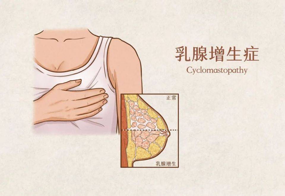 乳腺增生疼痛位置图片