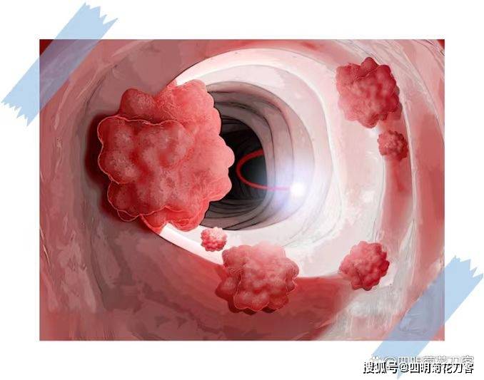 「彭医生谈肛肠」肠息肉,是癌症前奏吗?_癌变_大肠_检查