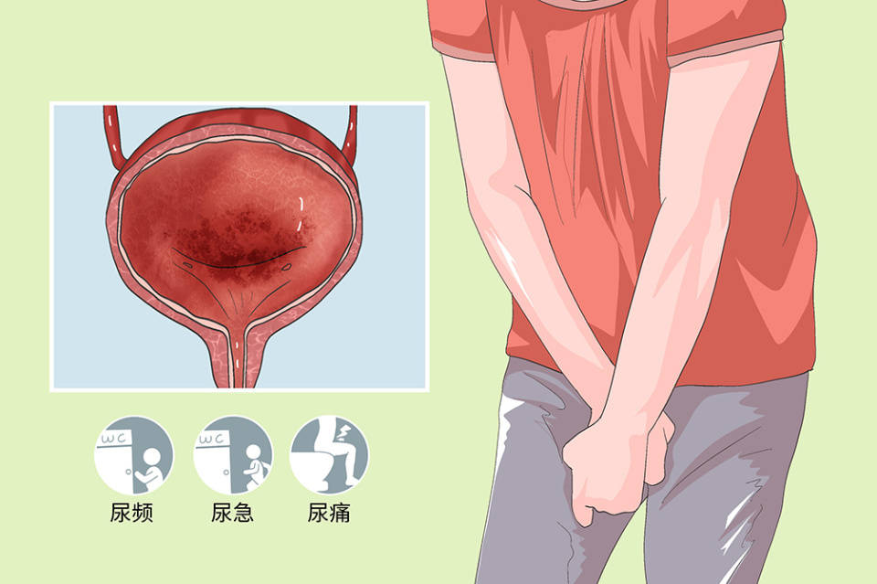 男性尿道粘连症状图片图片