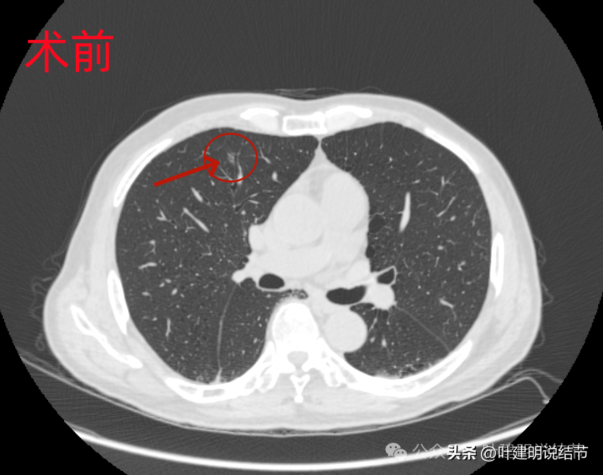 罕见病例剖析:微浸润性腺癌术后1年广泛转移?_淋巴结_肿瘤_病理学