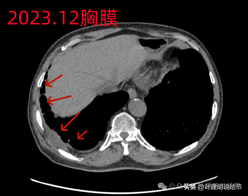 在a醫院檢查發現右上葉磨玻璃結節,於b醫院查pet-ct,提示右上葉前段磨