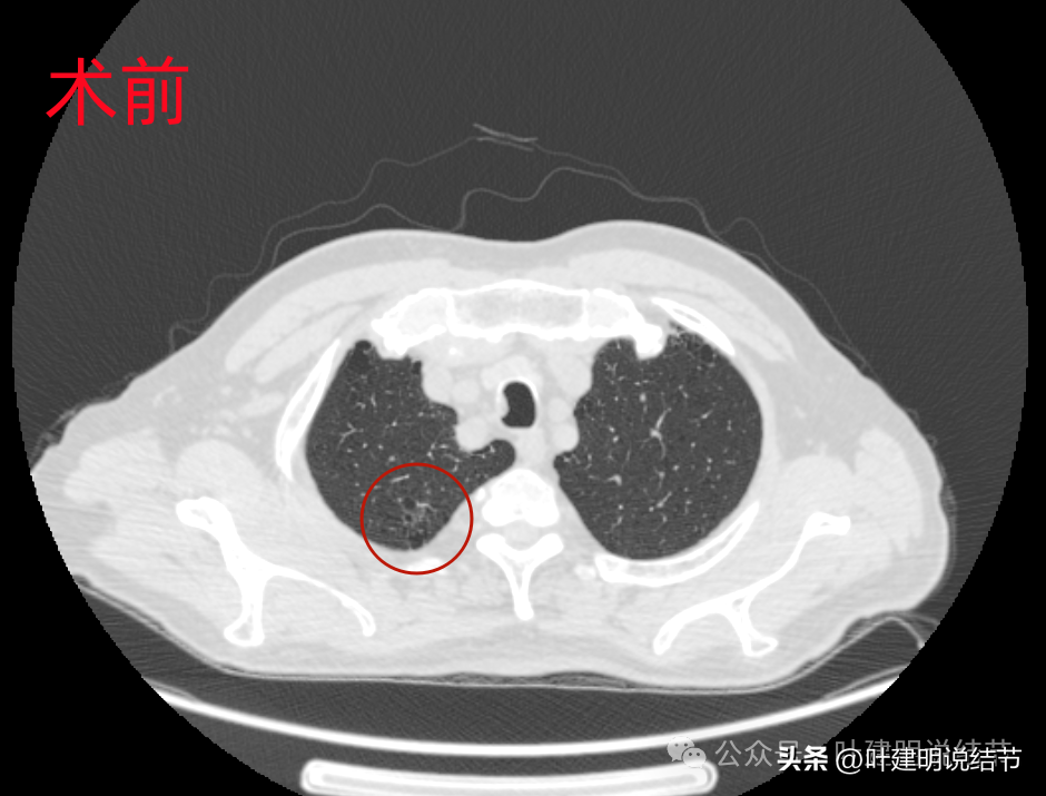 罕見病例剖析:微浸潤性腺癌術後1年廣泛轉移?_淋巴結