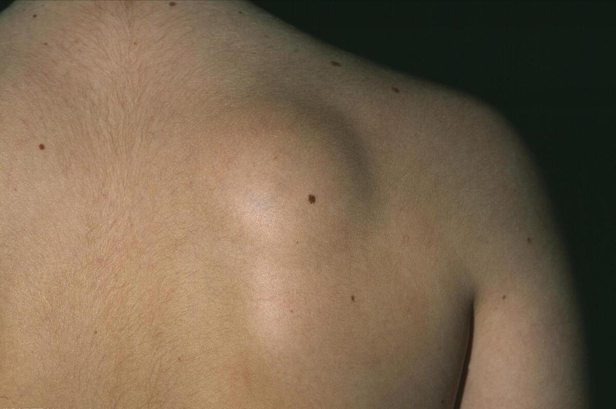 脂肪肉瘤误诊脂肪瘤图片
