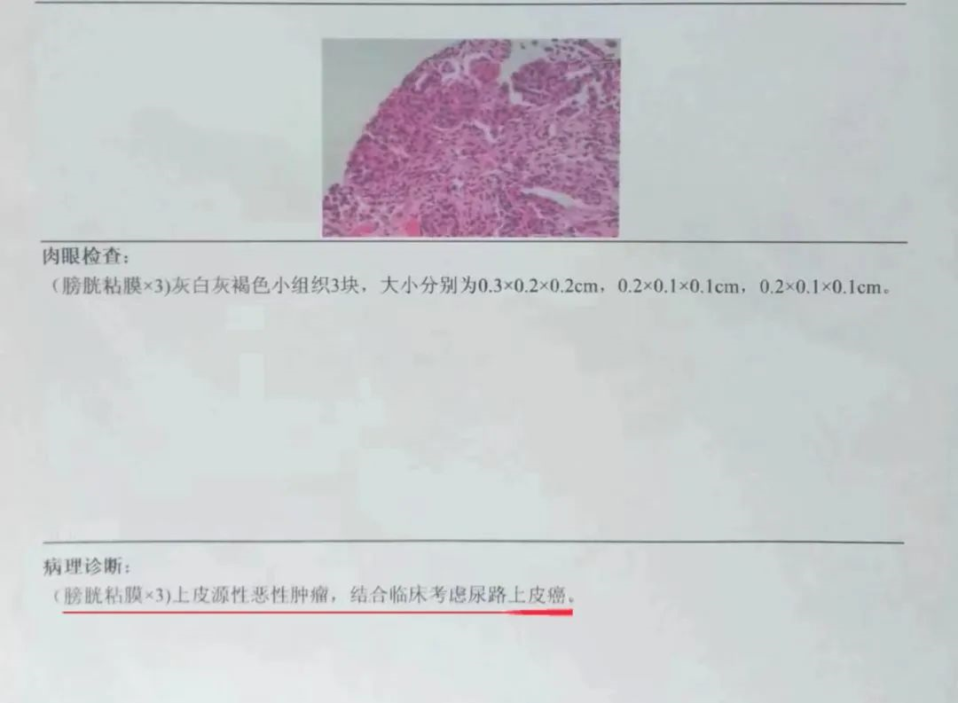 膀胱癌 病理报告图片