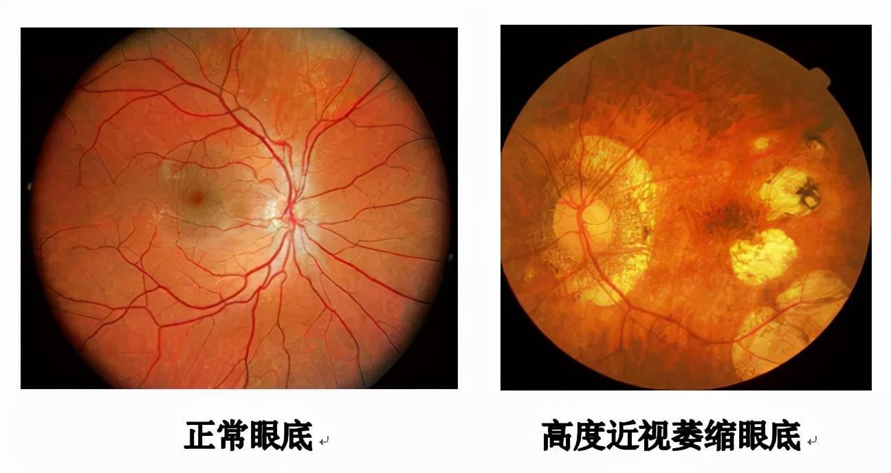 上海眼科院长:高度近视做白内障手术难度大吗?会出现并发症吗?
