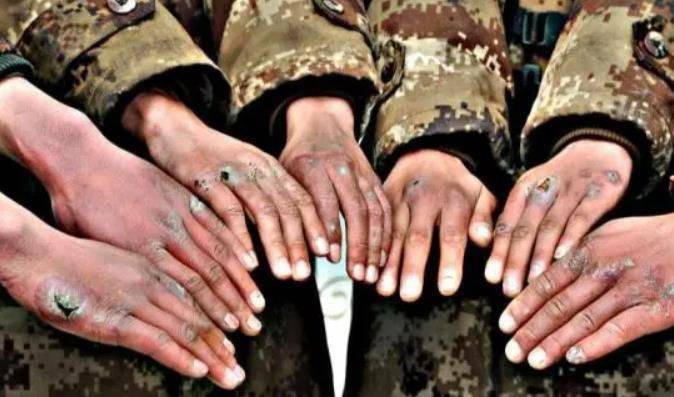 冻伤该挂什么科?_部位_衣物_身体